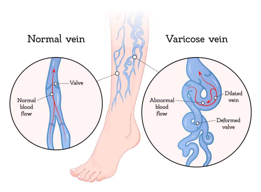 How Compression Stockings Can Help with Varicose Veins - St Johns