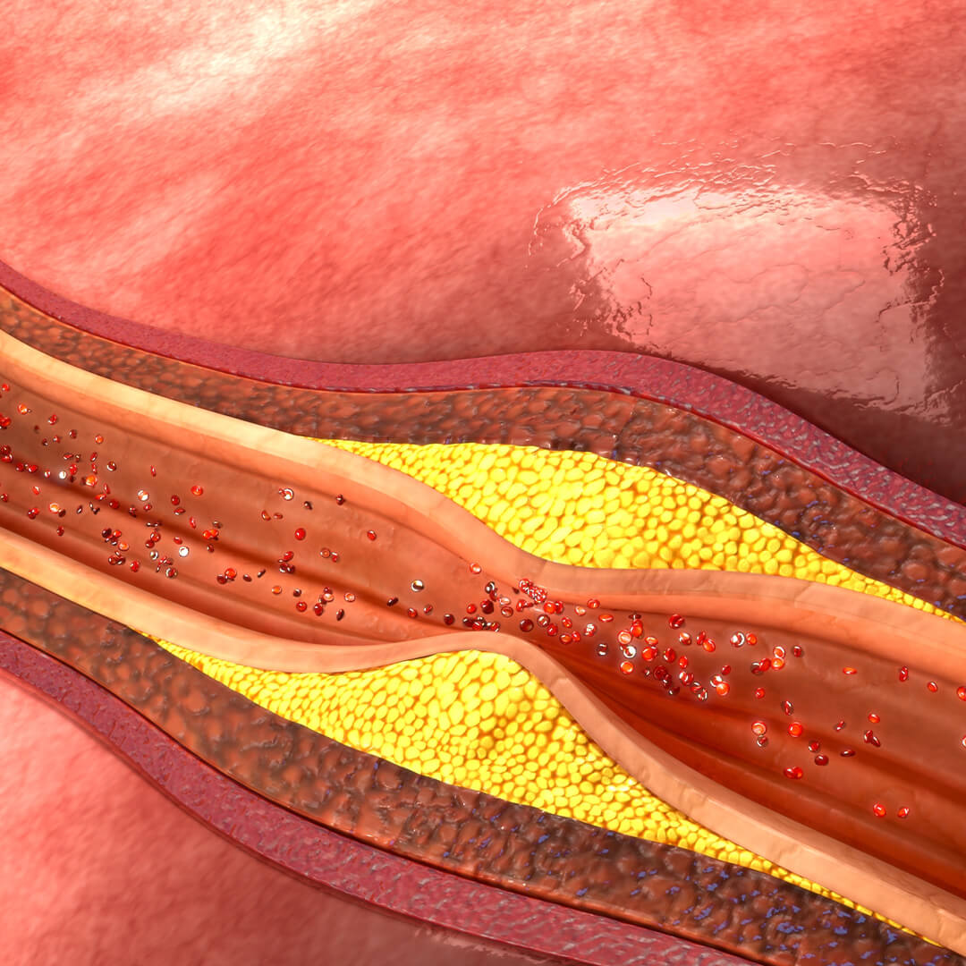 The build-up of fats, cholesterol and other substances in and on the artery walls.
